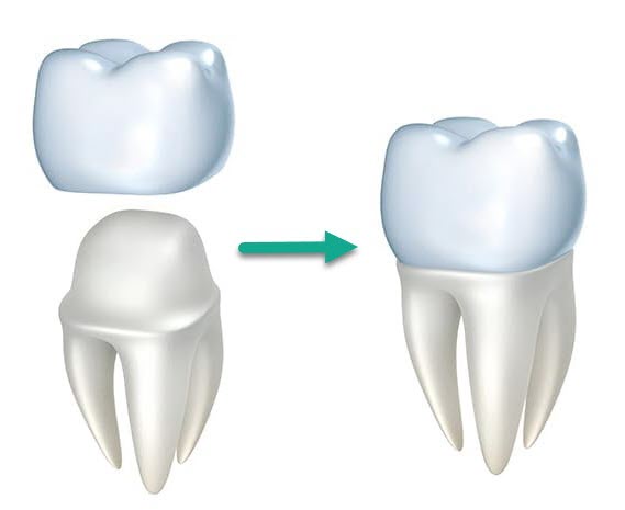 dental crown example