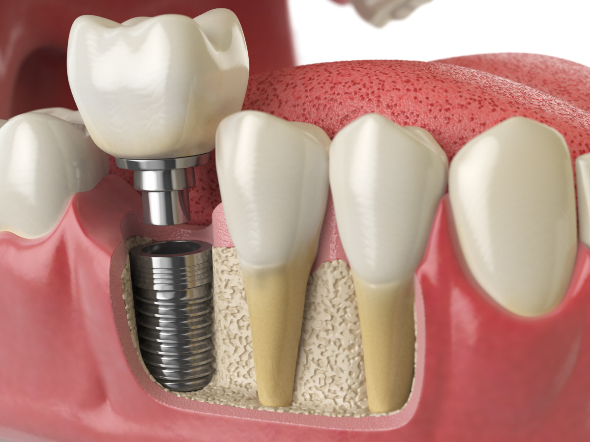 Dental Implants(1)