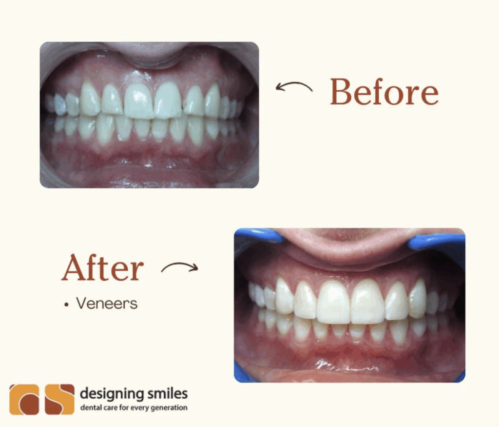new teeth veneers in roseville mn